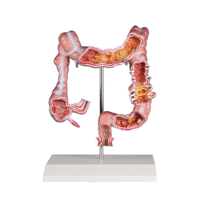 Colon Diseases Model